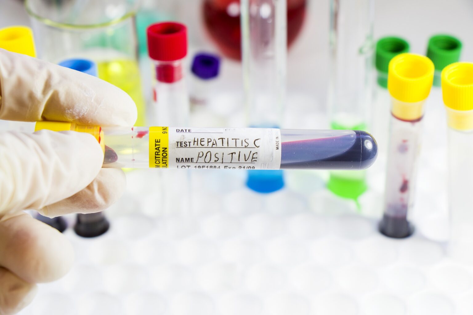  Publicación del informe mundial de hepatitis (abril 2024)